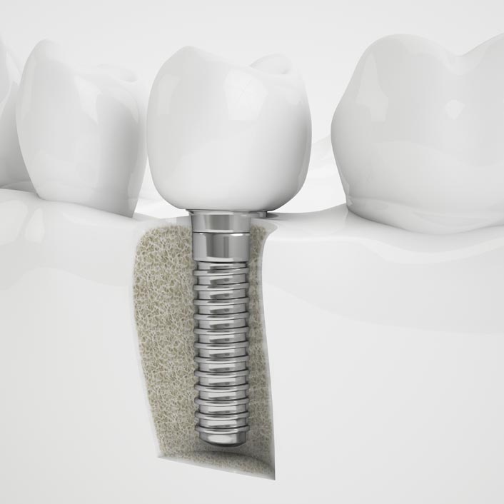 Dental Implant Restorations by Tagle & Castillo Cosmetic & Family Dentistry in McAllen, TX