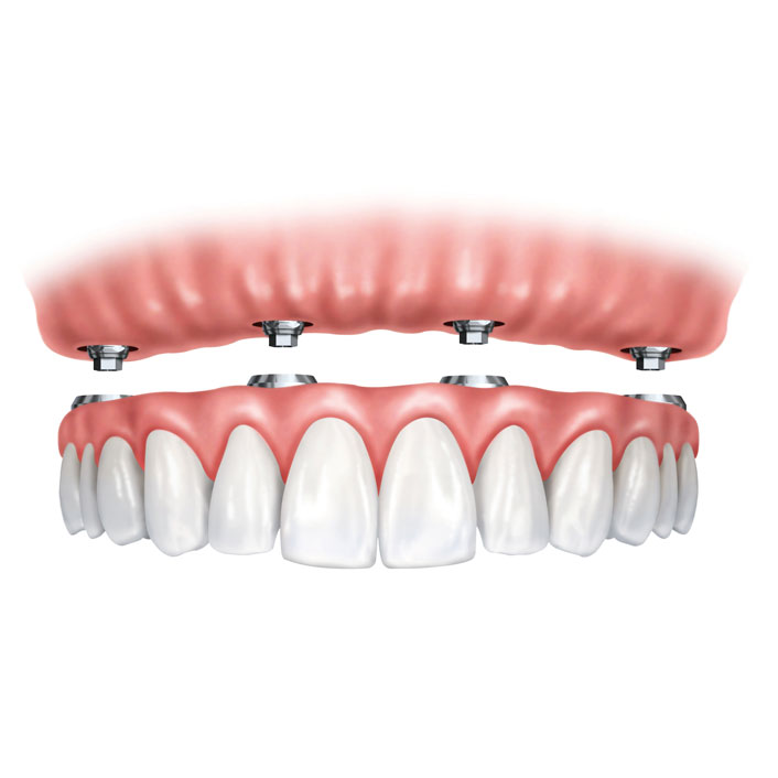 Implant Supported Dentures by Tagle & Castillo Cosmetic & Family Dentistry in McAllen, TX