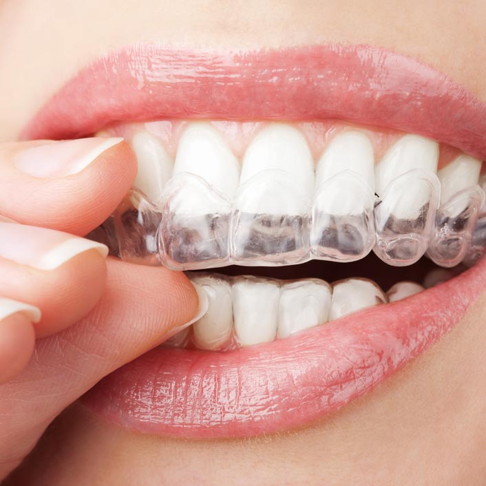 Invisalign offered by Tagle & Castillo Cosmetic & Family Dentistry near me in McAllen, TX