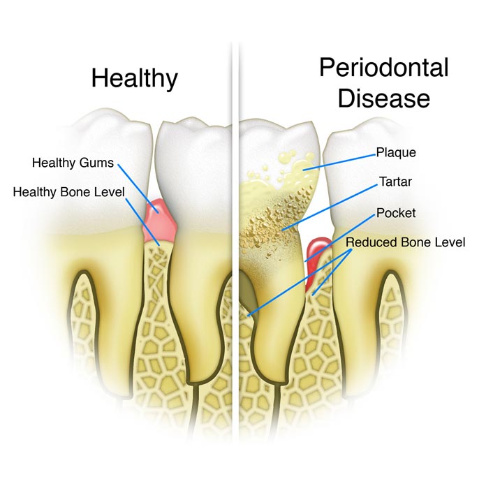 Gum Treatment services by Tagle & Castillo Cosmetic & Family Dentistry in McAllen, TX