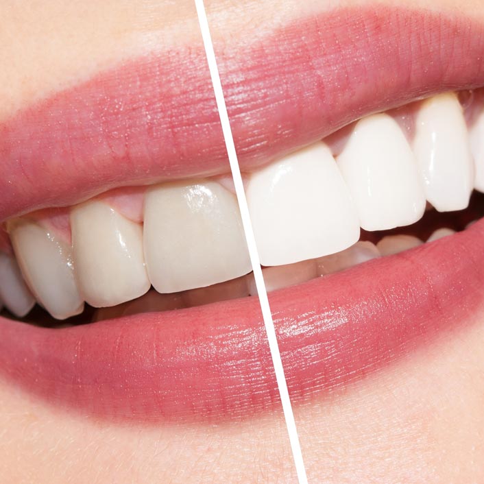 Teeth Whitening services by Tagle & Castillo Cosmetic & Family Dentistry in McAllen, TX